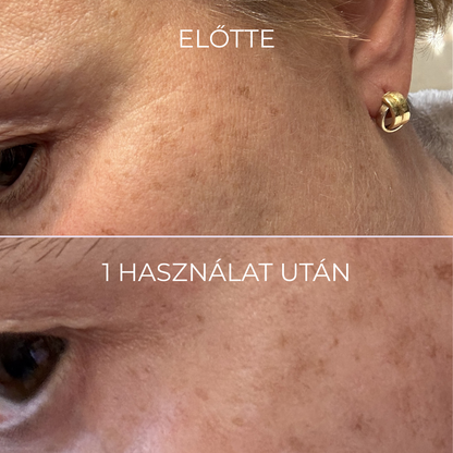 Szem alatti ráncok kezelése Karéya mikrotűs tapasszal
